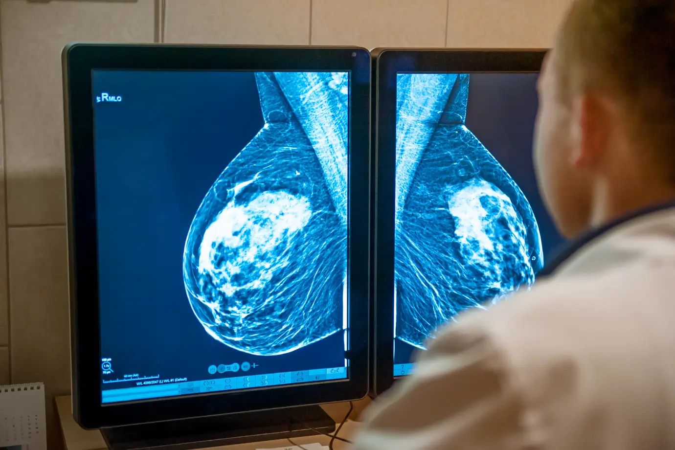 Mammography